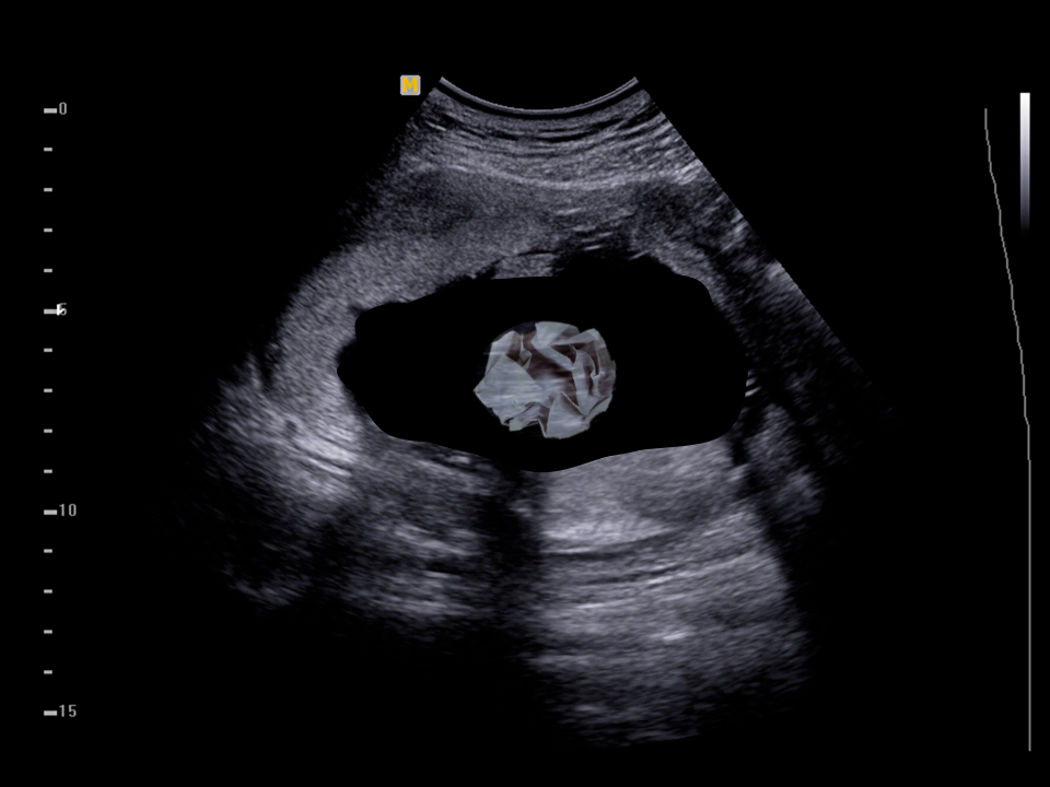 An ultrasound showing a crumpled up piece of newspaper.